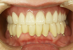 コーヌス義歯の症例 術後