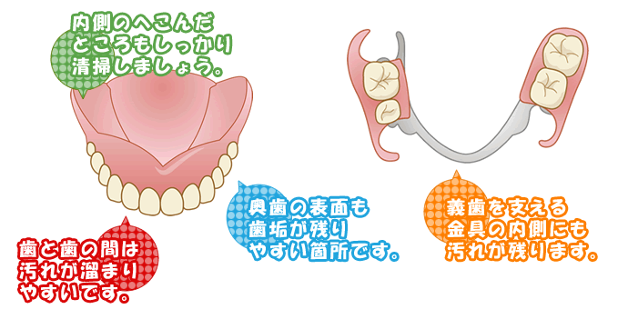 入れ歯磨きのポイント