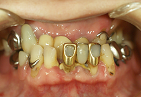 コーヌス義歯の症例 術前