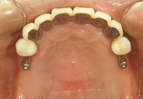 バネのない入れ歯の症例 術中