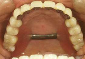 バネのない入れ歯の症例 術前