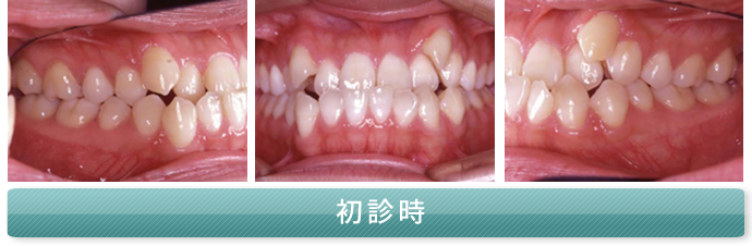 反対咬合（はんたいこうごう）初診時