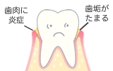 歯垢がたまる。歯肉に炎症。