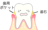 歯周ポケット、歯垢。