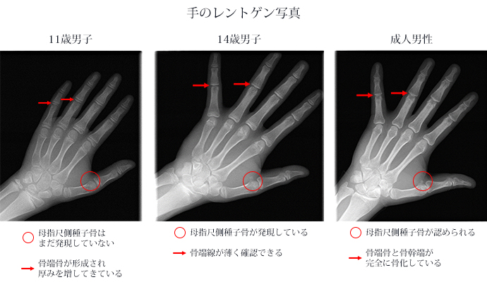 手のレントゲン写真
